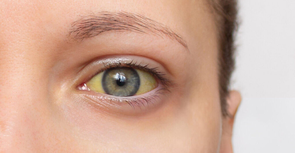 jaundice treatment at gastroenterology hospital in Chhatrapati Sambhajinagar GI One Hospital
